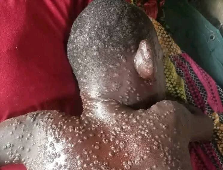 Immagine-WhatsApp-2025-07-07-ore-18.09.57_5886ceb1 Guinée : 7 épidémies actives font surface